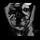 Acute diverticulitis, perforation, peritonitis, pneumoperitoneum: CT - Computed tomography